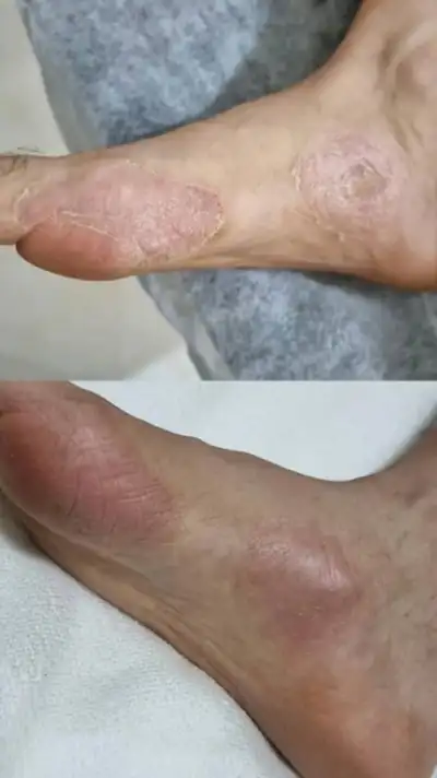 نمونه واقعی روند بهبود یک ضایعه مزمن پوستی