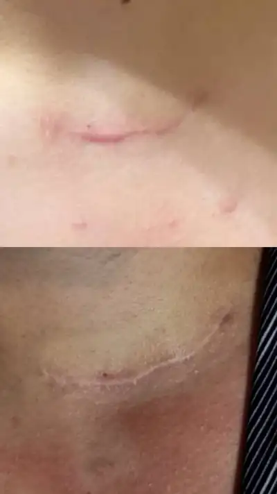 تصویر روند قبل و بعد از بهبود اسکار با رویکرد بازساختی
